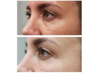 Tratamiento de ojeras - 642970