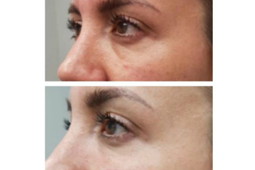 Tratamiento de ojeras antes y después - 642970