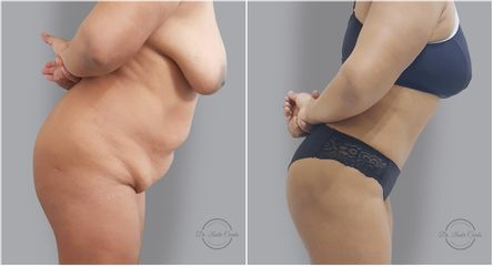 Abdominoplastia - Dr. Nadir Carda