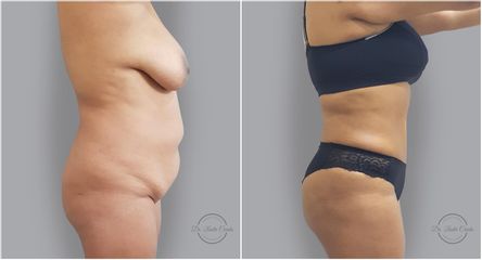 Abdominoplastia - Dr. Nadir Carda