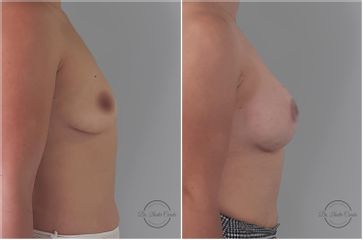 Aumento mamario  - Dr. Nadir Carda