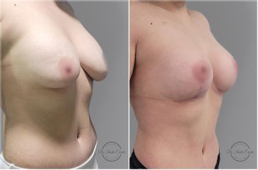 Mastopexia - Dr. Nadir Carda