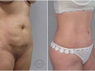 Lipoláser antes y después - 842027