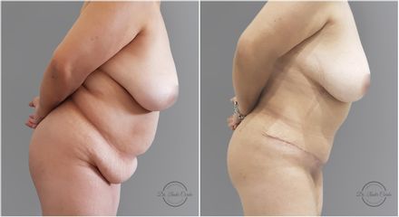 Abdominoplastia - Dr. Nadir Carda