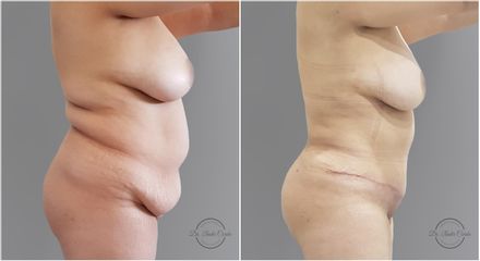 Abdominoplastia - Dr. Nadir Carda