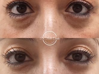 Tratamiento de ojeras antes y después - 868947