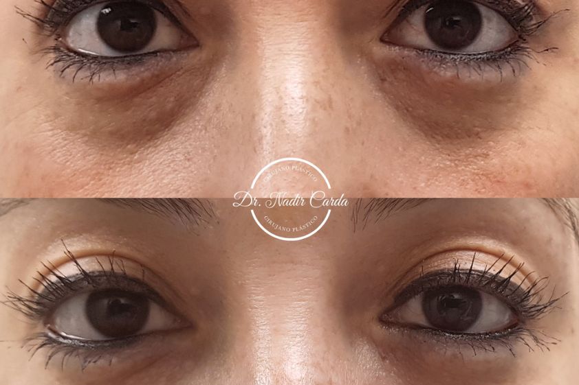 Tratamiento de ojeras antes y después - 868947