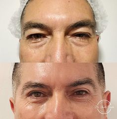 Blefaroplastia - Dr. Nadir Carda