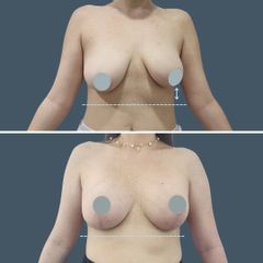 Mastopexia- Dr. Nadir Carda