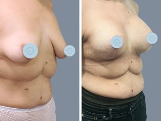 Mastopexia antes y después - 872872