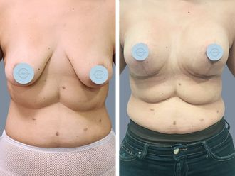 Mastopexia antes y después - 872874