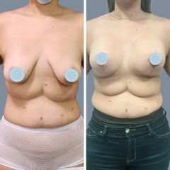 Mastopeixa con implantes mamarios - Dr. Nadir Carda