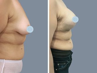 Mastopexia antes y después - 872875
