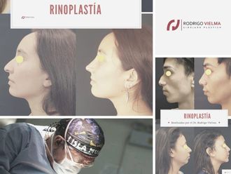 Rinoplastia - 828418