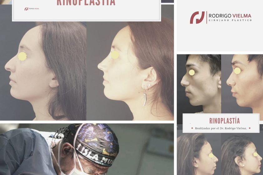 Rinoplastía antes y después - 828418