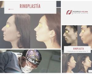 Rinoplastia - Dr. Rodrigo Vielma