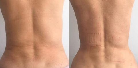 Liposucción - Dr. Rodrigo Vielma