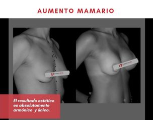 Aumento mamario - Dr. Rodrigo Vielma