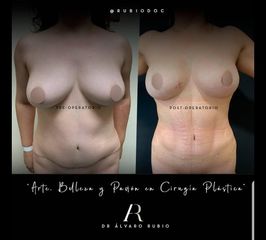 Lipoescultura
