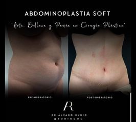 Abdominoplastia