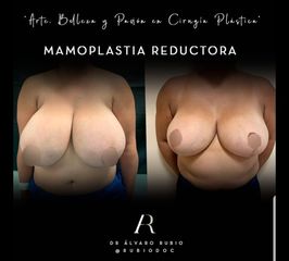 Reducción de Mamas