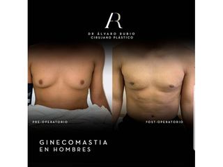 Ginecomastia