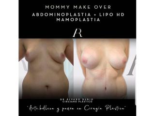 Mommy makeover