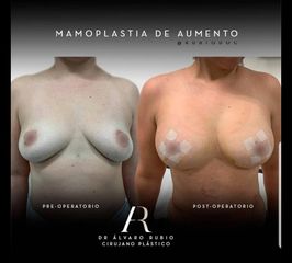 Mamoplastia de Aumento