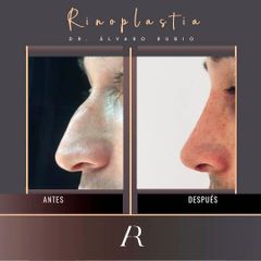 Rinoplastia - Alvaro Rubio González