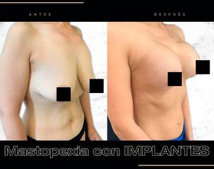 Mastopexia - Alvaro Rubio González