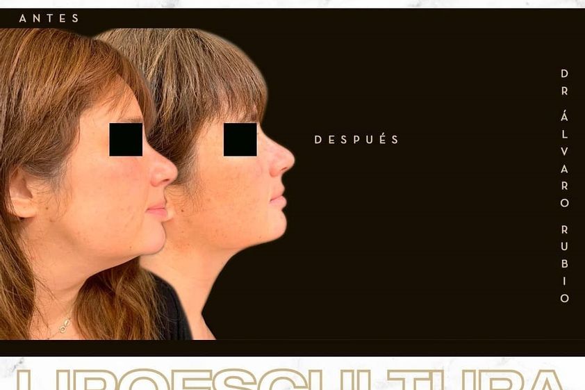 Bolas de Bichat antes y después - 775657