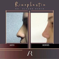 Rinoplastia - Alvaro Rubio González