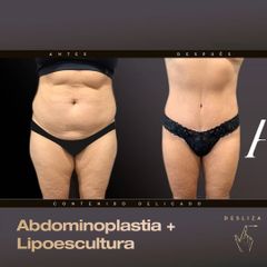 Abdominoplastia - Alvaro Rubio González