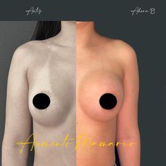 Aumento mamario - Dr. Alvaro Rubio González
