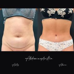 Abdominoplastia - Dr. Alvaro Rubio González