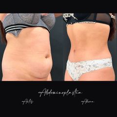 Abdominoplastia - Dr. Alvaro Rubio González