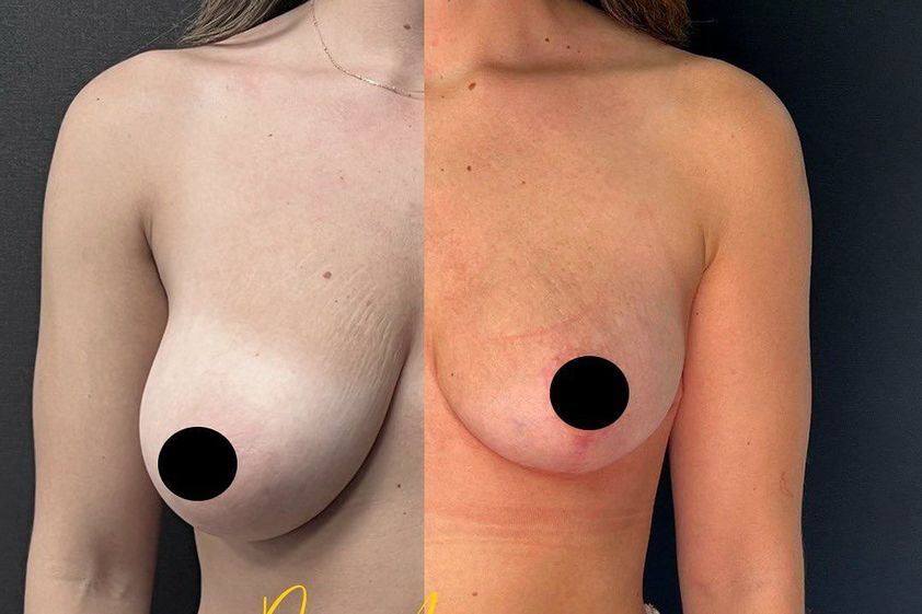 Mastopexia antes y después - 859584