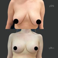 Mastopexia - Dr. Alvaro Rubio González