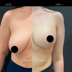 Aumento mamario - Dr. Alvaro Rubio González