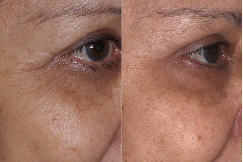Tratamiento de ojeras antes y después - 836505