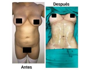 Lipo VASER HD