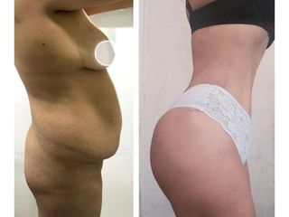 Abdominoplastia - Dr. Brian Frick
