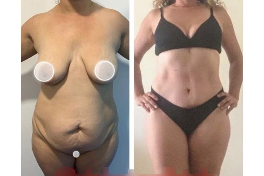 Lipoescultura antes y después - 738157