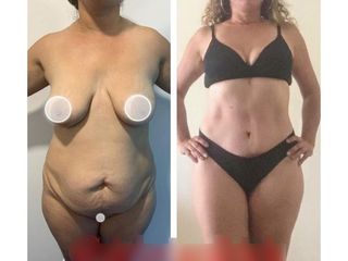 Lipoescultura - Dr. Brian Frick