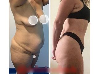 Abdominoplastia - Dr. Brian Frick