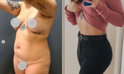 Abdominoplastia - Dr. Brian Frick