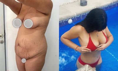 Abdominoplastia - Dr. Brian Frick