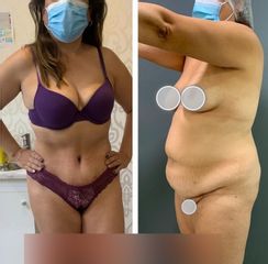 Abdominoplastia - Dr. Brian Frick 