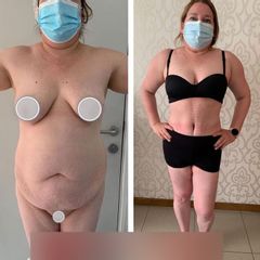 Lipoabdominoplastia - Dr. Brian Frick