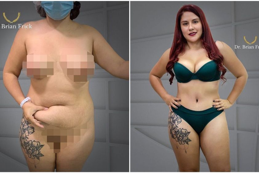 Abdominoplastía antes y después - 801731